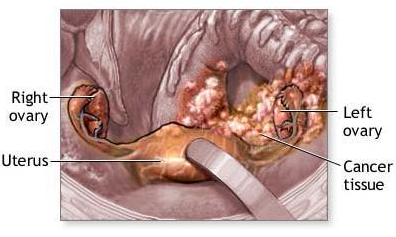 Atlante ed epitome della ginecologia . Fig. 34.-atrofia cirrotica senile  dell'ovaio.. Fig. 35.-degenerazione oligocistica dell'ovaio. Infiammazioni  dei tubi. (Fig. 36.) Questa osalpingite dell'oforo è combinata con la  peritrosalpingite, la peri-metro