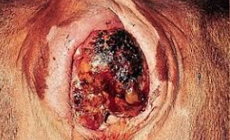 Vaginal Carcinoma