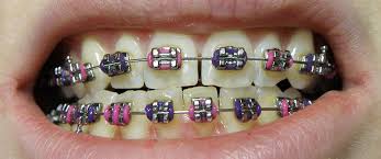 March: I got braces in my teeth!
