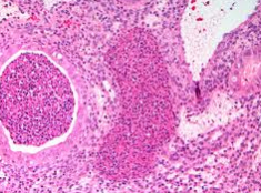 Acute endometritis