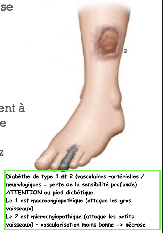 Traitement et complications:
Le traitement consiste en la pose de prothèse artérielle (stents), qui ressemblent à ceux utilis