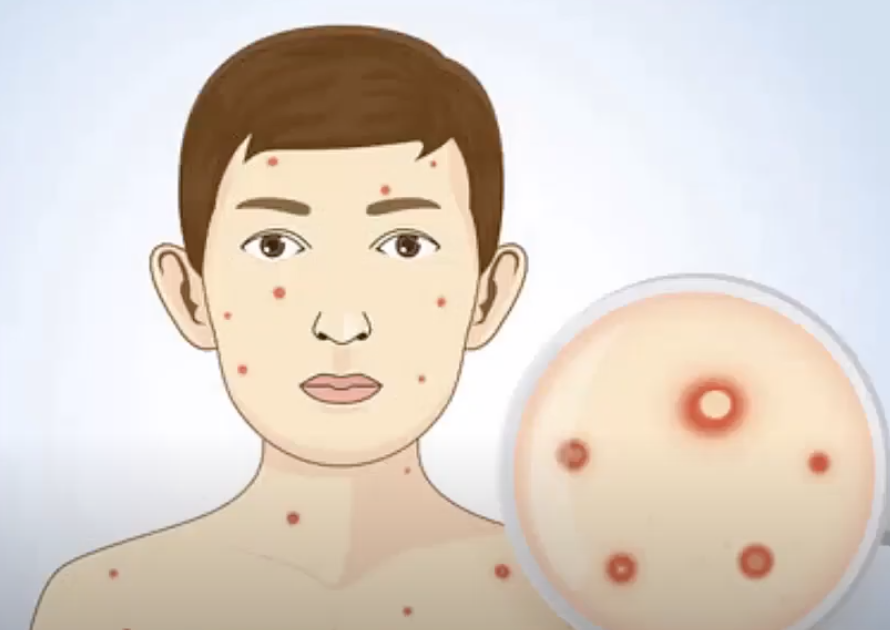 Acne-like lesions on skin