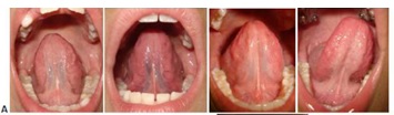 FRENILLO TIPO A - NORMAL:              Fijación en medio de la cara inferior de la lengua y, en el piso de la boca, generalme