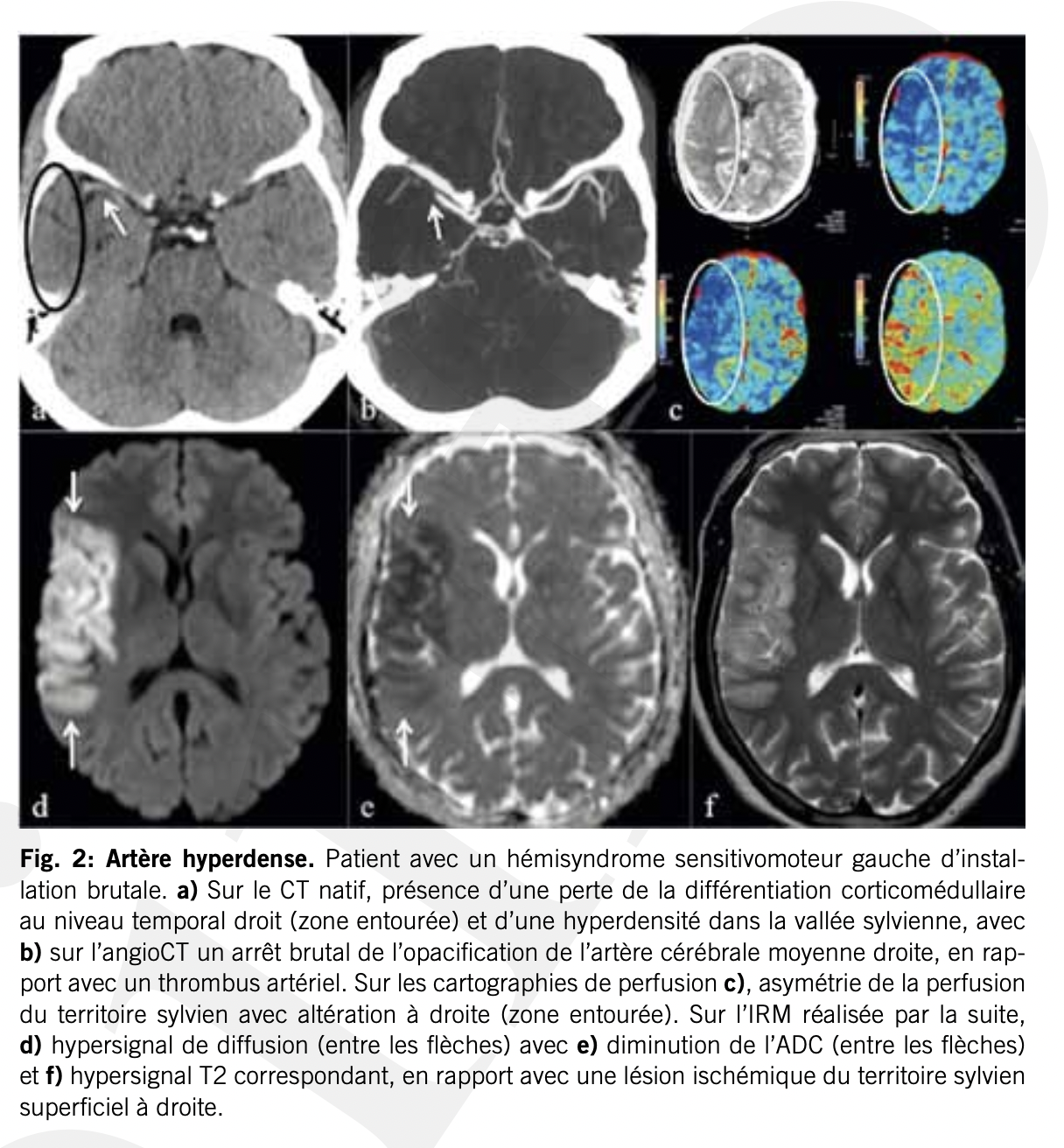 Diagnostic:
Imagerie d'urgence Scan (acquisition plus rapide de l'image) ou IRM (bonne définition également mais acquisition 