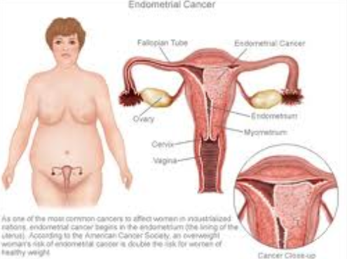 Endometrial Carcinoma