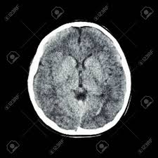 TAC cerebro