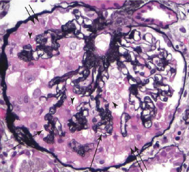 "glomerulopatía colapsante"