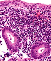 Cronic Endometritis