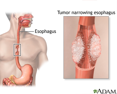 a example of esophageal cancer