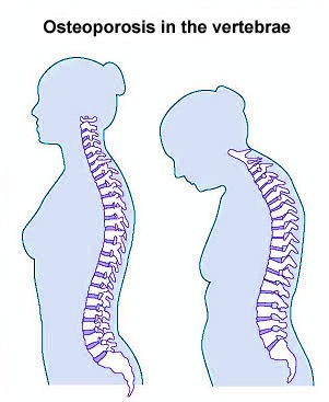 (osteoporosis is a skeletal disease that weakens the vertebrae)