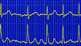Rapid or irregular heartbeat