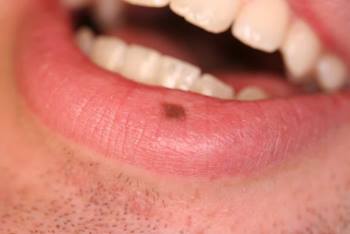 Les macules:
Ce sont des taches de petit diamètre s’effaçant à la vitropression. Ex: rubéole