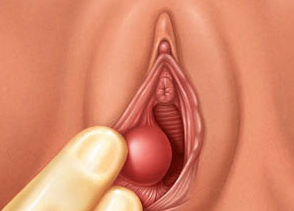 Bartholin Cyst