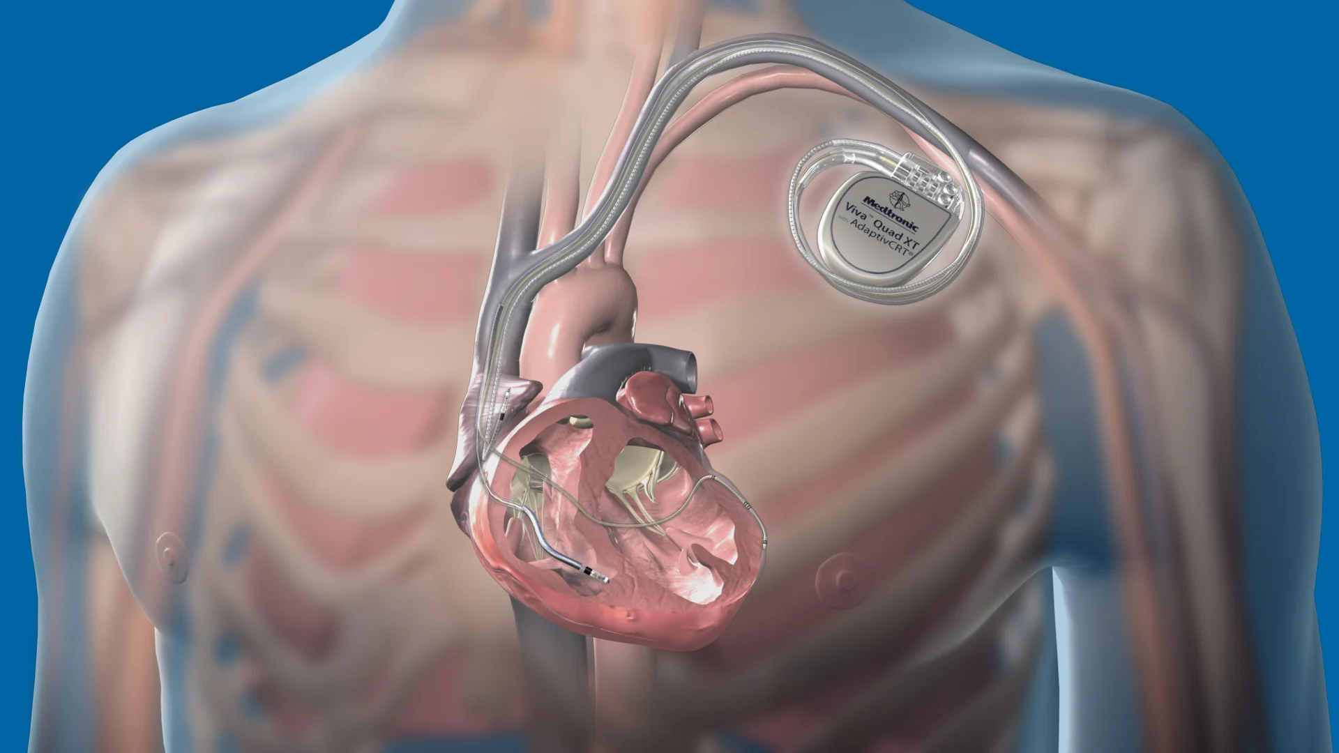 Implantable cardioverter defibrillator (IDC)