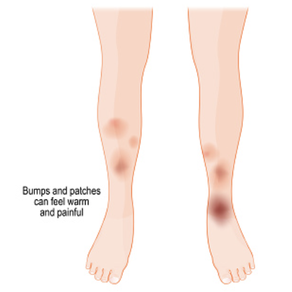 Erythema nodosum-like lesions