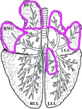 Bronconeumonía supurativa (lobular).