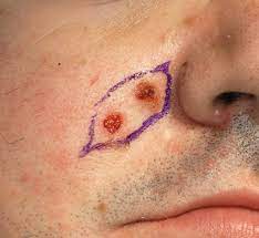 Le manifestazioni cutanee insorgono nella tarda infanzia o adolescenza e consistono in carcinomi basocellulari multipli, a vo