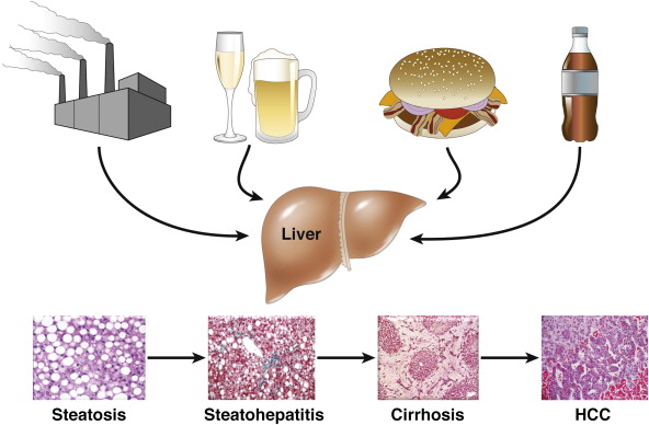 The Stages of Liver Damage