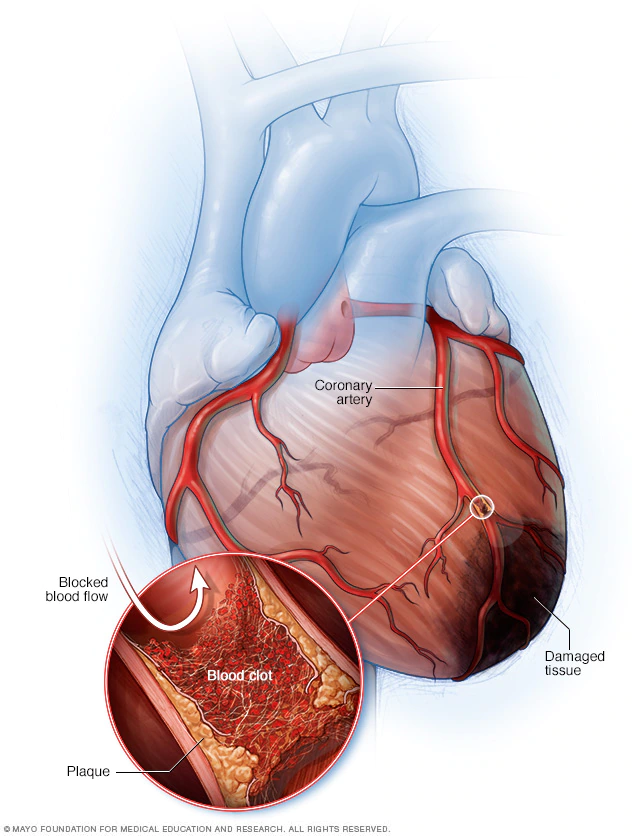diagram displaying how your heart looks when a heart attack is present