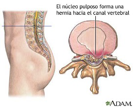 Hernia de núcleo pulposo lumbar (GES**)

Protrusión del material gelatinoso central de un disco intervertebral a través de un