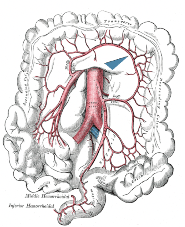 Ischémie et infarctus mésentérique:
L’infarctus mésentérique est une occlusion brutale de l’artère mésentérique supérieure, r