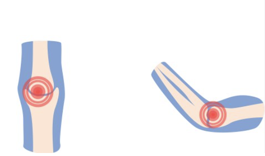 Arthritis