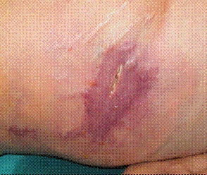 Burning injuries