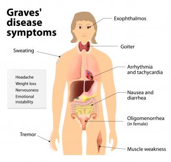 Graves' disease - autoimmune disorder - immune system produces antibodies that activate thyroid hormone production