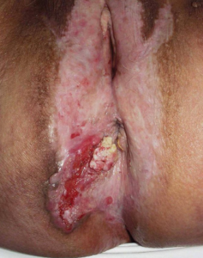 Lichen Simplex chronicus