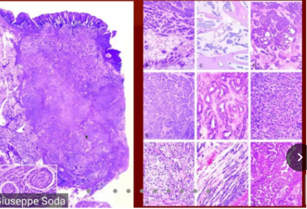 adenocarcinoma polimorfo di basso grado