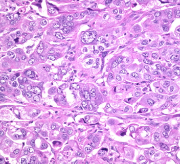Clear cell Adenocarcinoma