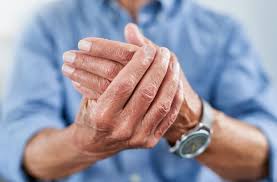 Arthritis