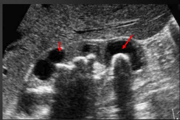 Ecografía de riñón plano longitudinal: imágenes hiperecogénicas (flecha) con sombra acústica posterior , por litiasis con dil
