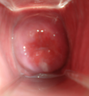 Cervix