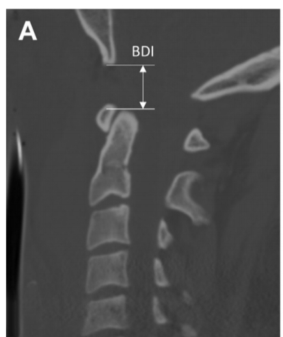 Dislocación
- ⬆️ Letal ☠️
- ⬆️ Int. basion odontoideo 
- ➕ avulsión(basión, odontoides, condilos).