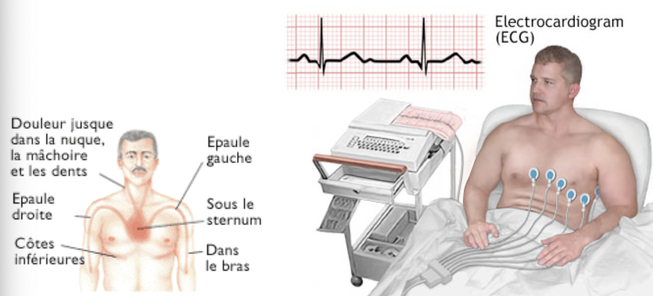 Traitement:
Le traitement en dehors de la chirurgie qu’elle soit invasive (directement sur le coeur) ou non (pose de stent pa