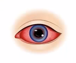 Eye inflammation