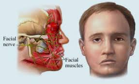 PARALISIS FACIAL PERIFERICA INTRATEMPORAL A CAUSA DE UNA OTITIS MEDIA AGUDA