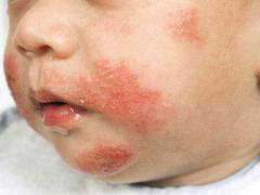Eczéma constitutionnel:
C’est un maladie sans facteur génétique connu mais qui évolue toujours sur un terrain familial atopiq