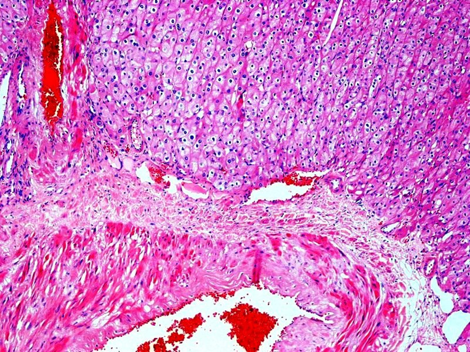 carcinoma que no invade la vena renal
