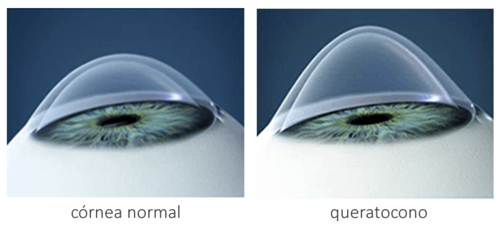 Queratocono