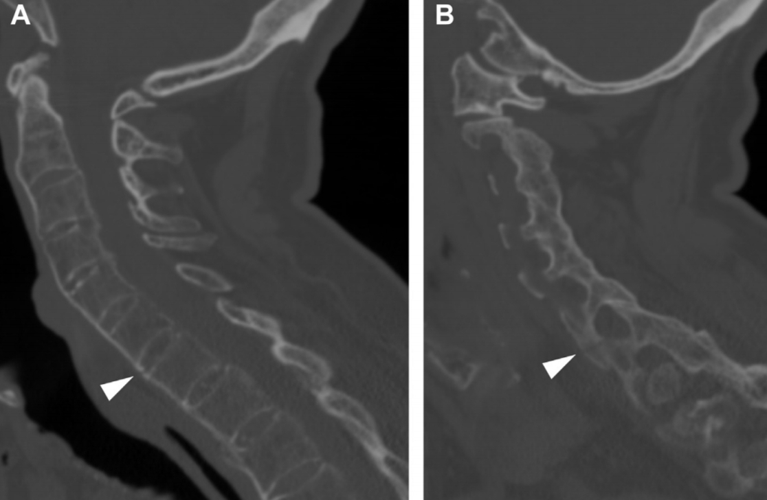 FX hiperextensión(inestables)
⬇️ neurologico
Fx horizontales de anterior a posterior