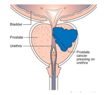 Prostate Cancer