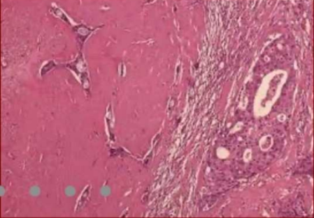 carcinoma ex adenoma pleomorfo