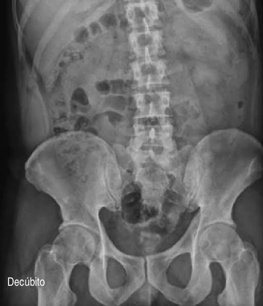 Proyección anteroposterior (AP) de abdomen en decúbito supino