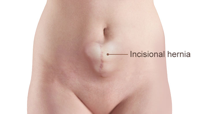 Incisional hernia