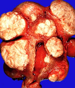 Leomyoma