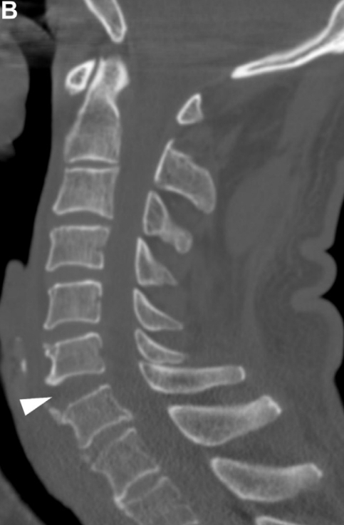 Luxación por hiperextensión 
- altamente inestable
- región cervical inferior 
- ensanchamiento sutil  disco intervertebral a