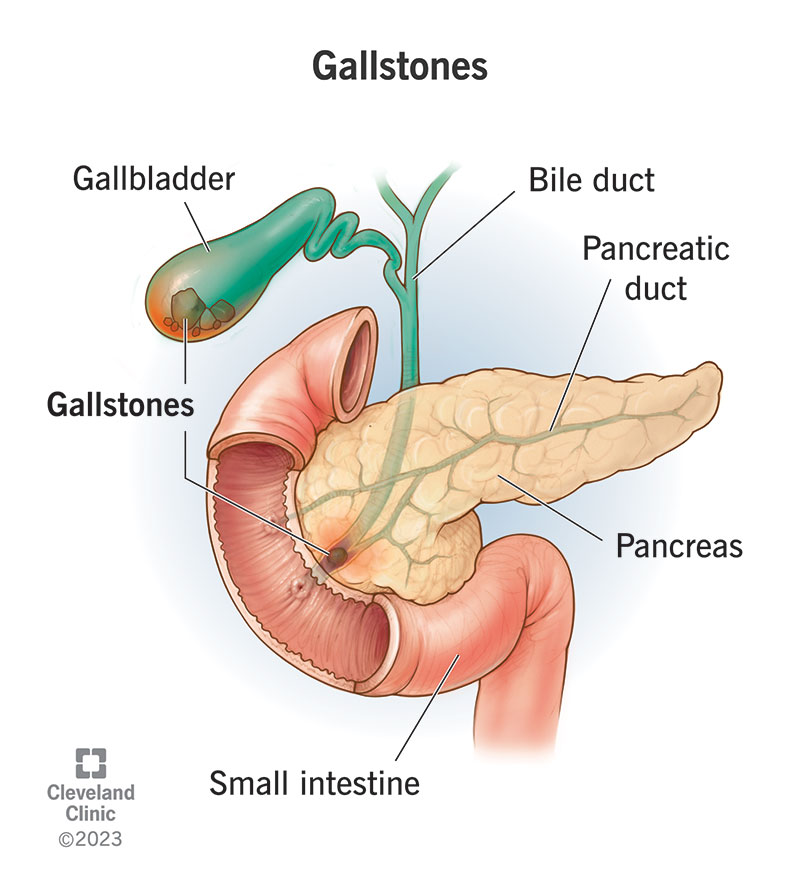 Gallstones are hard, pebble-like materials that start developing in the gallbladder. As the gallstones increase, the gallblad