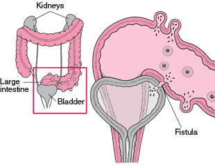 Fistula